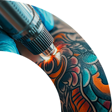 Rimozione Tatuaggi